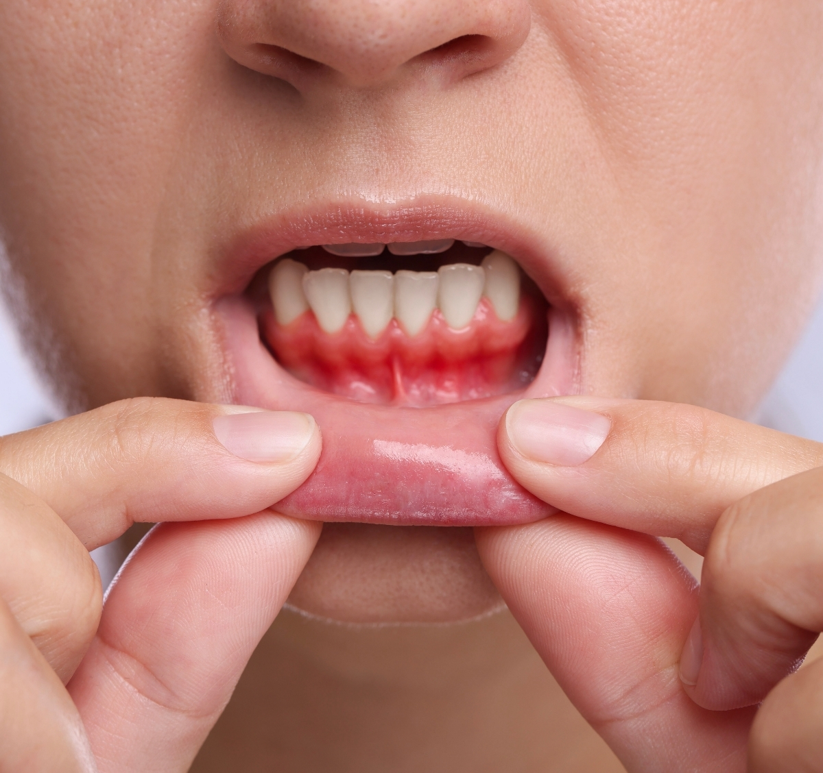 What Is Gum Disease
